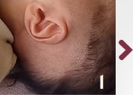 Infant ear prepared before molding