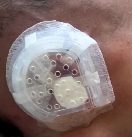 CranioWell set applied on an infant ear