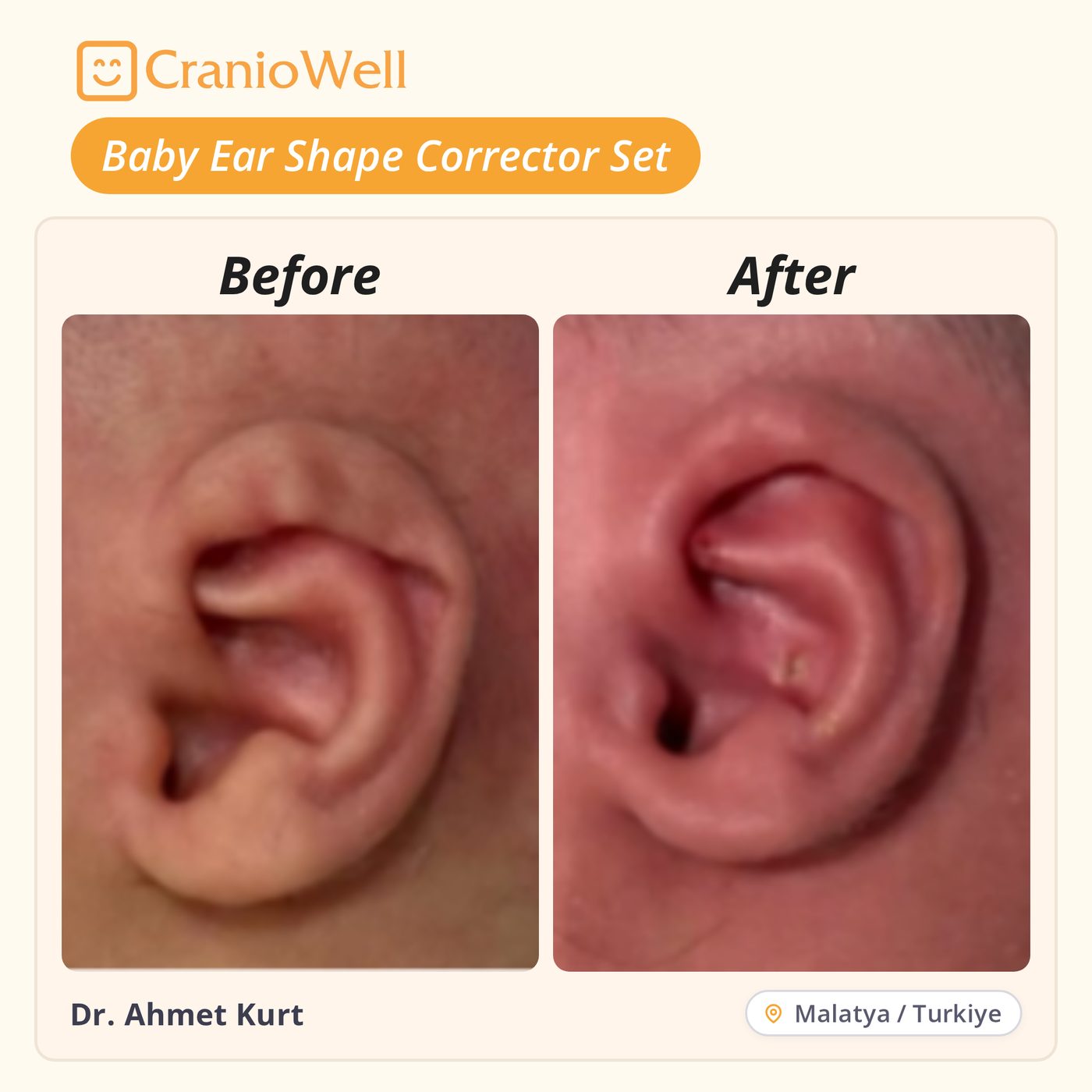 Before and after infant ear molding by Dr. Ahmet Kurt, Malatya