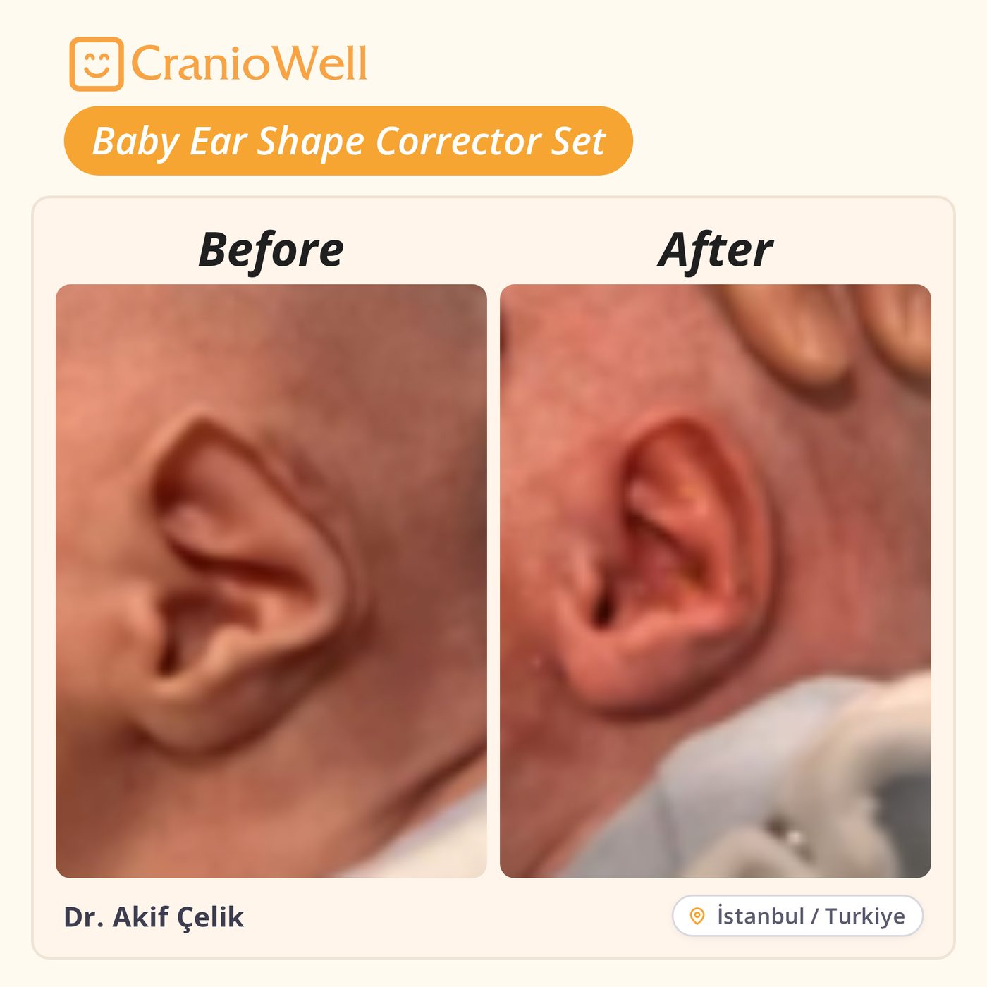 Before and after infant ear molding by Dr. Akif Çelik, İstanbul