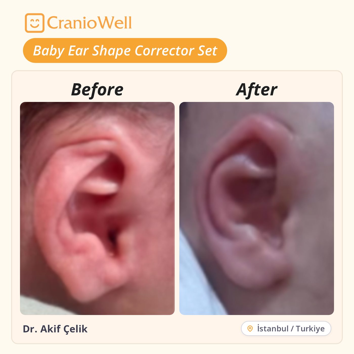 Before and after infant ear molding by Dr. Akif Çelik, İstanbul