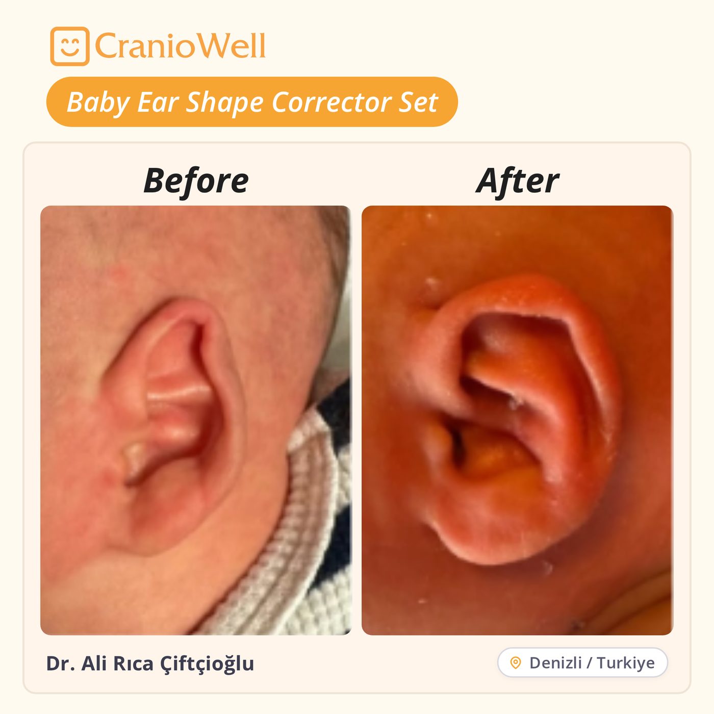 Before and after infant ear molding by Dr. Ali Rıca Çiftçioğlu, Denizli