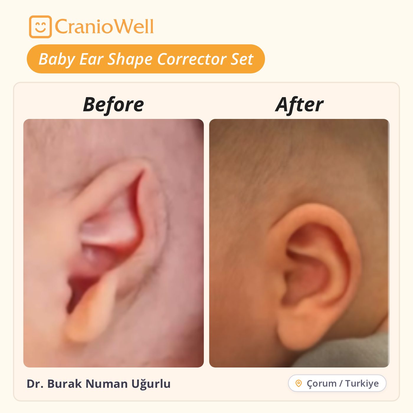 Before and after infant ear molding by Dr. Burak Numan Uğurlu, Çorum