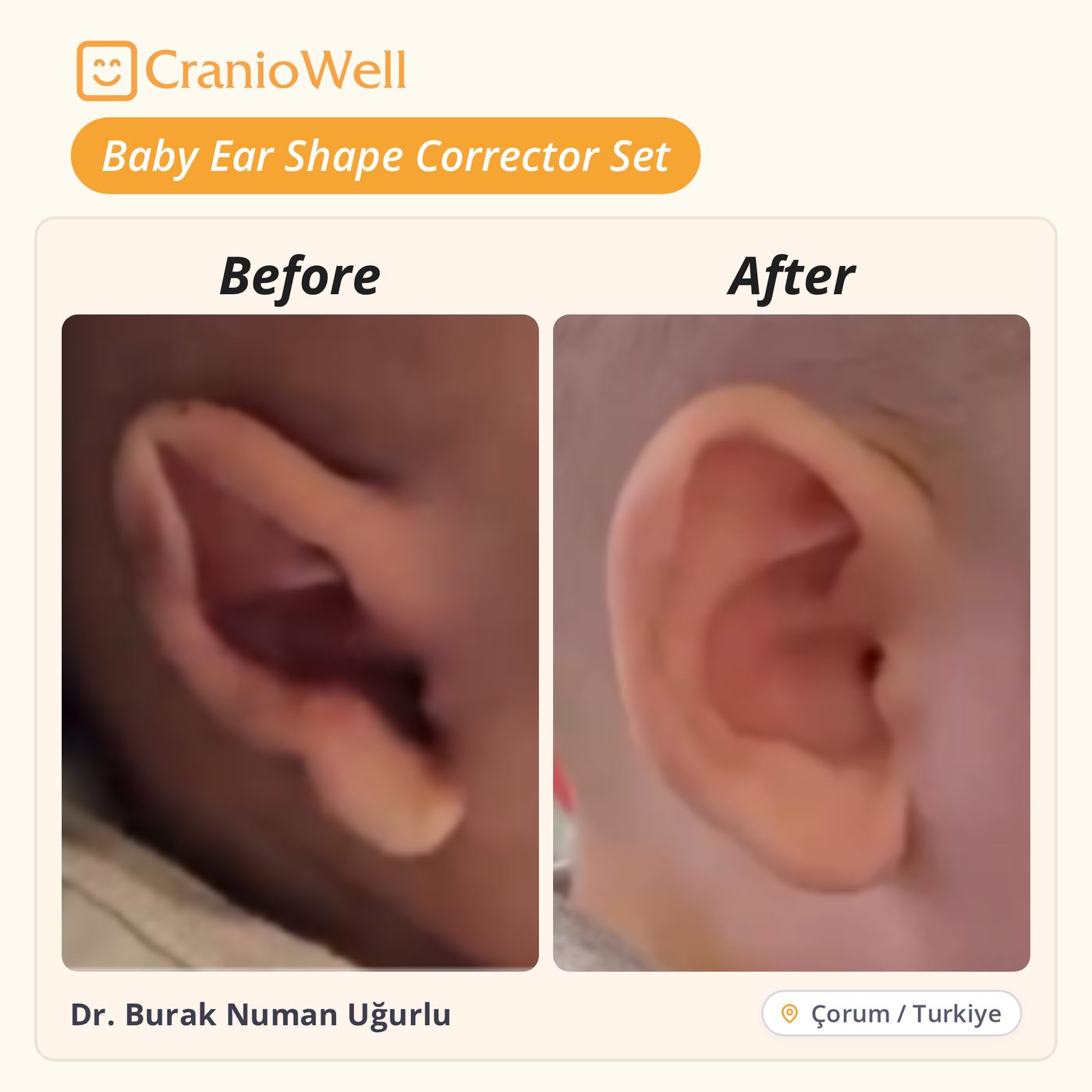 Before and after infant ear molding by Dr. Burak Numan Uğurlu, Çorum