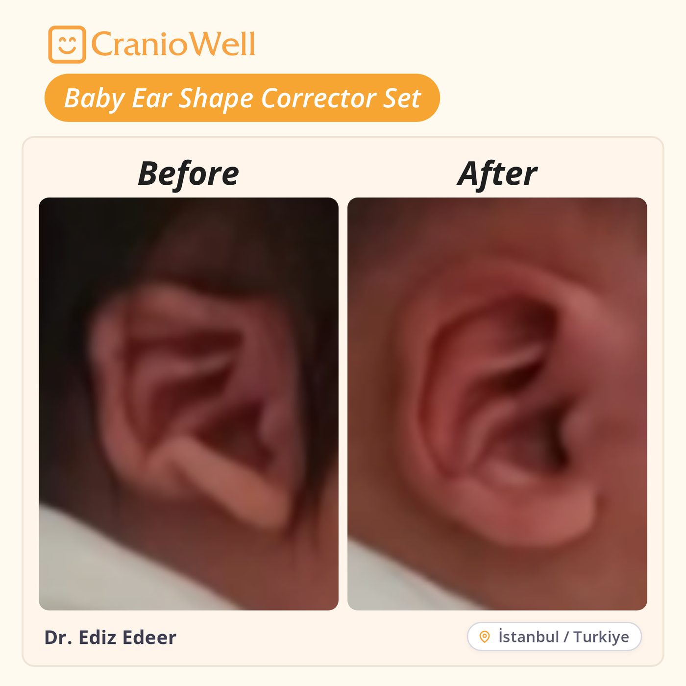 Before and after infant ear molding by Dr. Ediz Edeer, İstanbul