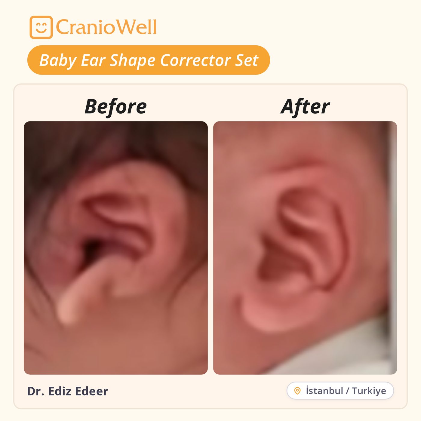 Before and after infant ear molding by Dr. Ediz Edeer, İstanbul