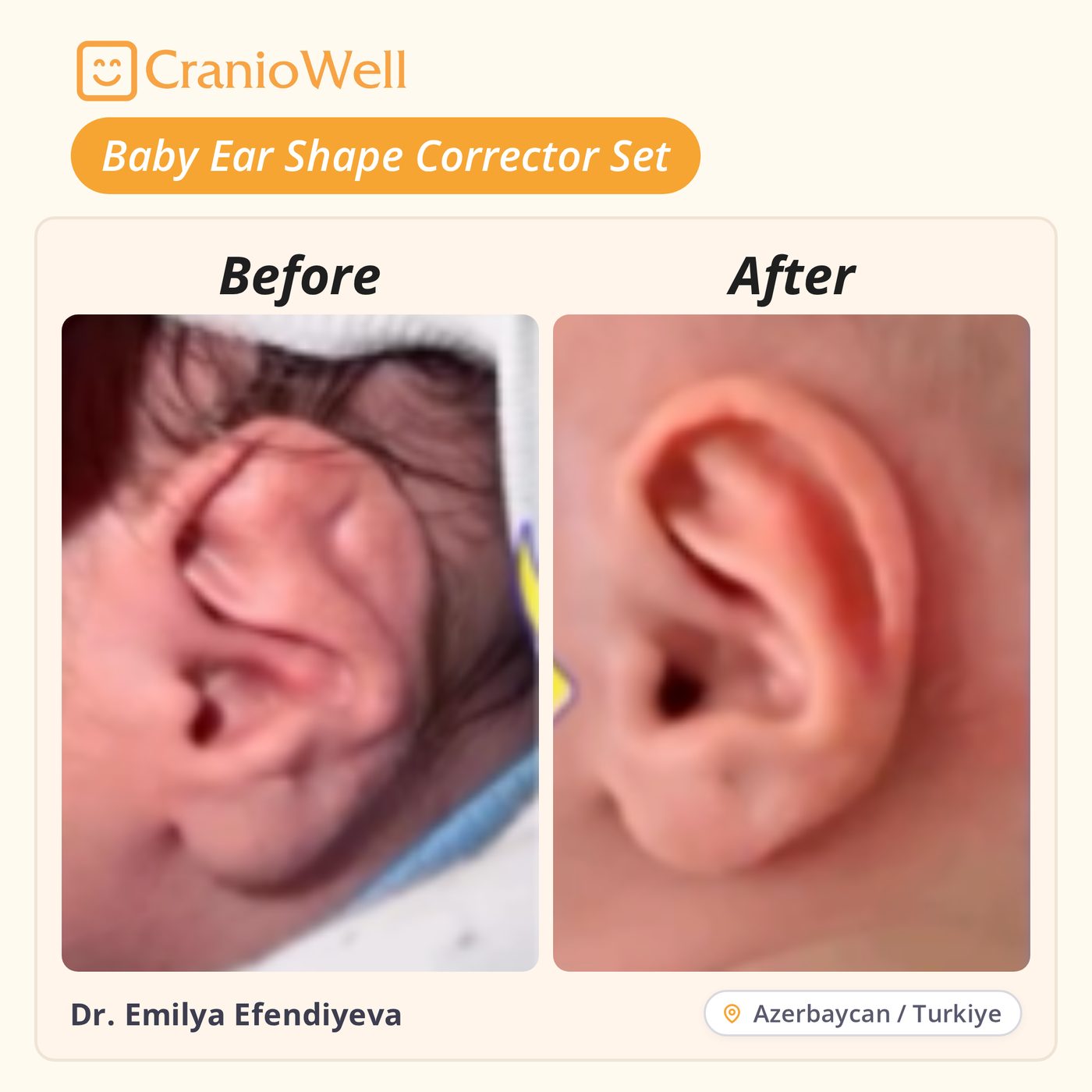 Before and after infant ear molding by Dr. Emilya Efendiyeva, Azerbaijan