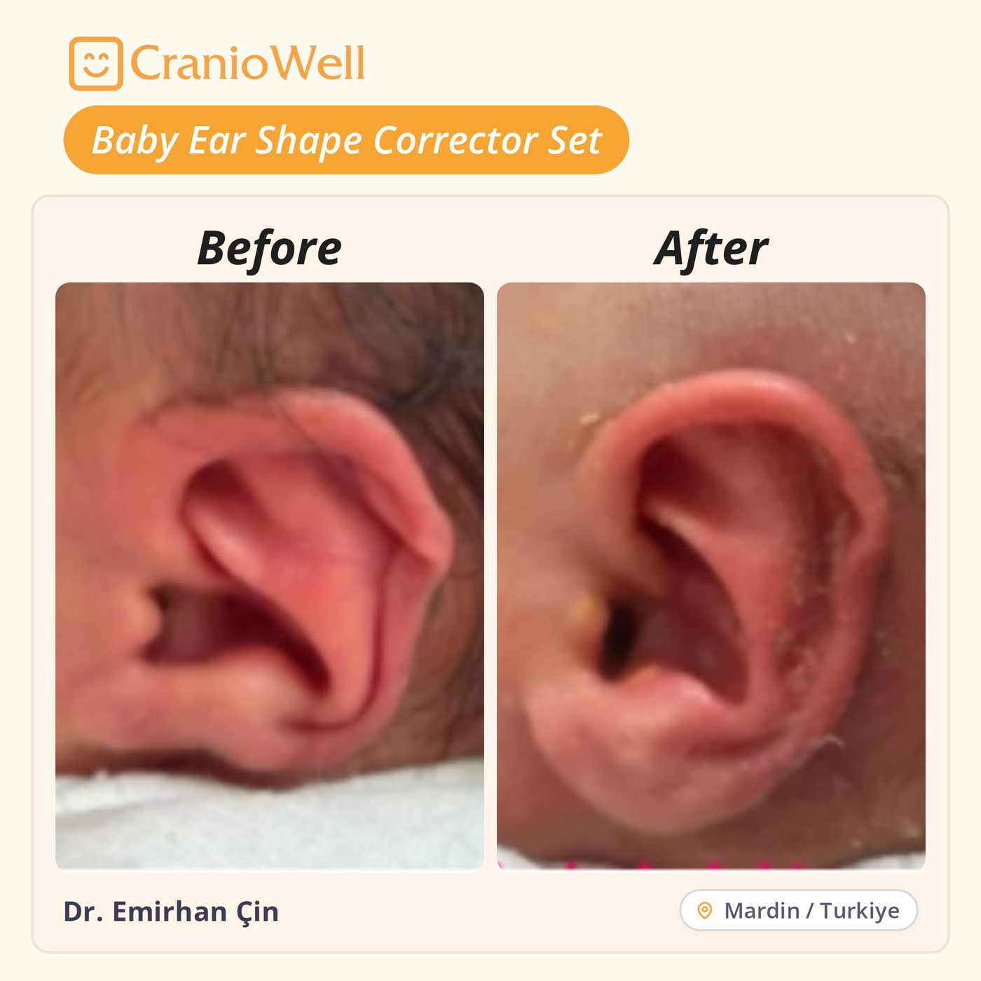 Before and after infant ear molding by Dr. Emirhan Çin, Mardin