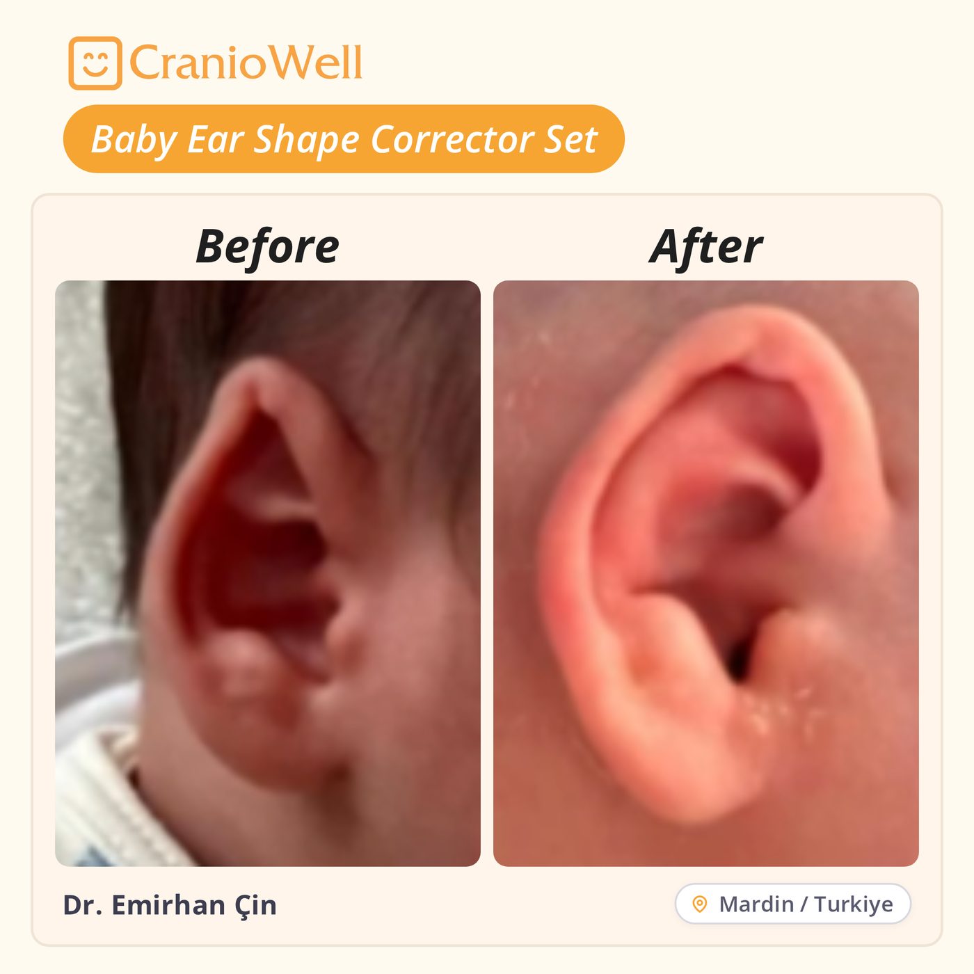 Before and after infant ear molding by Dr. Emirhan Çin, Mardin