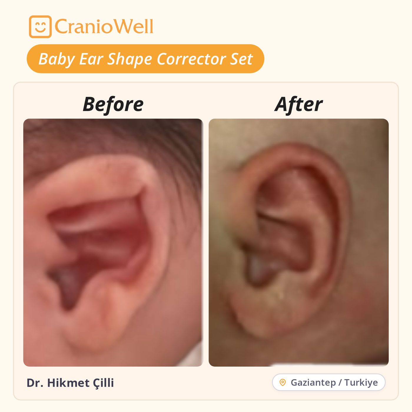 Before and after infant ear molding by Dr. Hikmet Çilli, Gaziantep