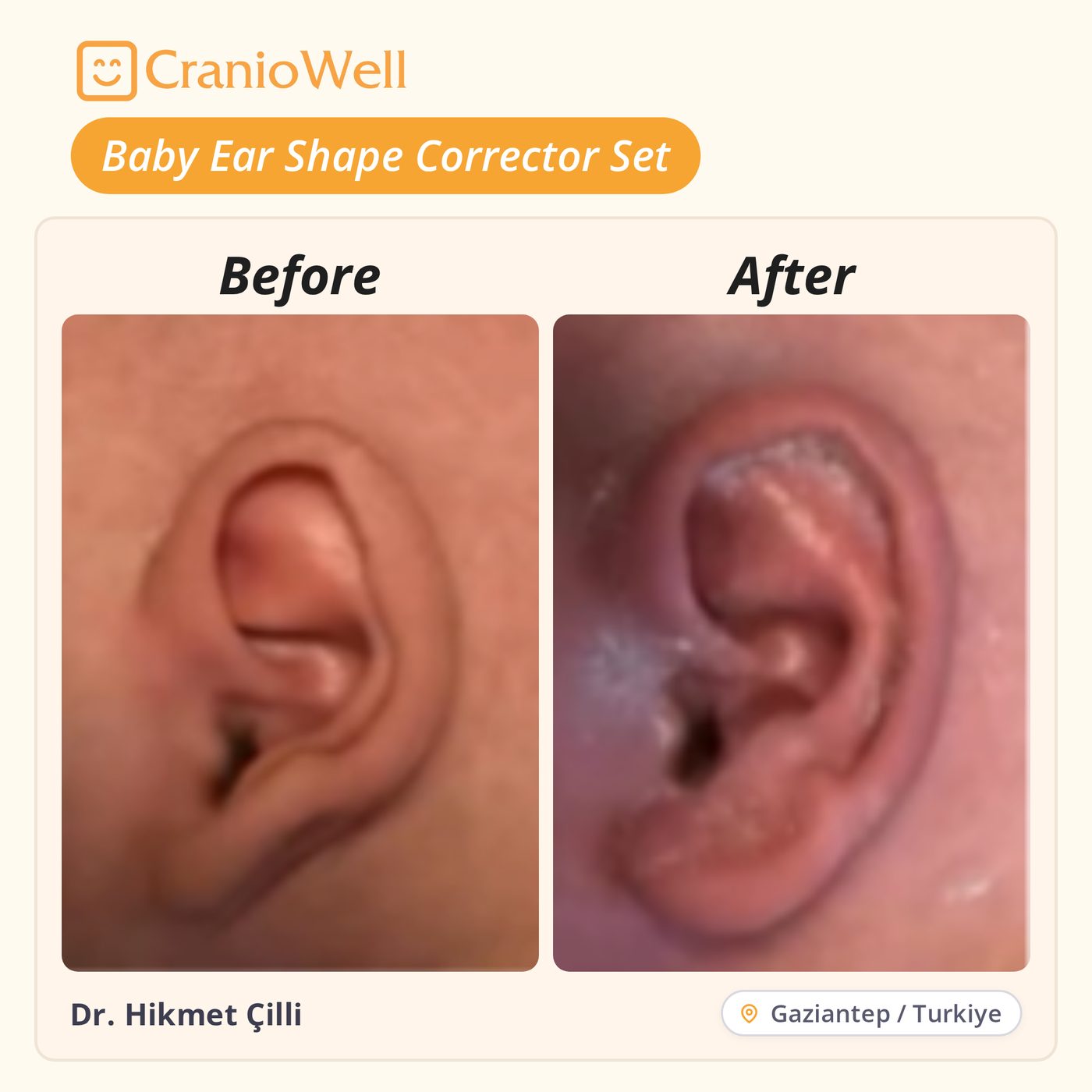Before and after infant ear molding by Dr. Hikmet Çilli, Gaziantep