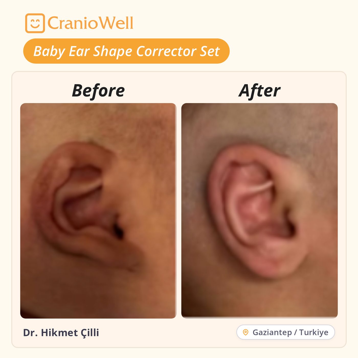 Before and after infant ear molding by Dr. Hikmet Çilli, Gaziantep