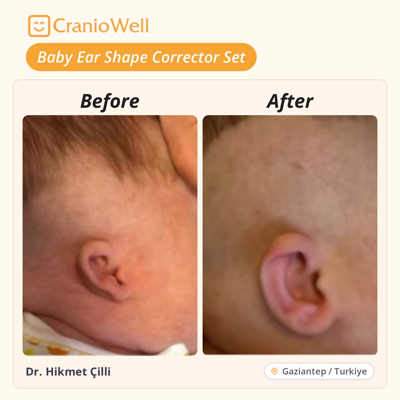 Before and after infant ear molding by Dr. Hikmet Çilli, Gaziantep