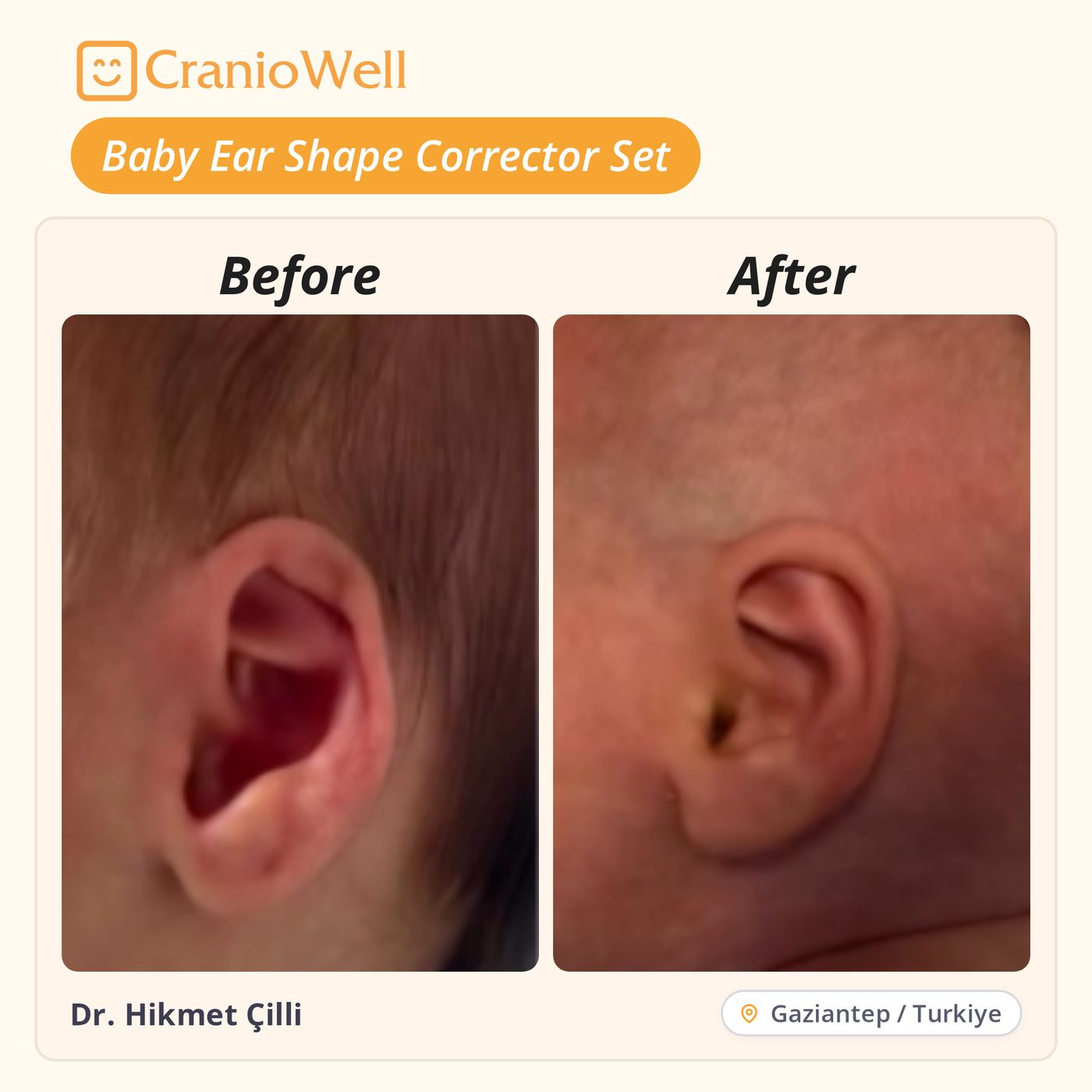 Before and after infant ear molding by Dr. Hikmet Çilli, Gaziantep