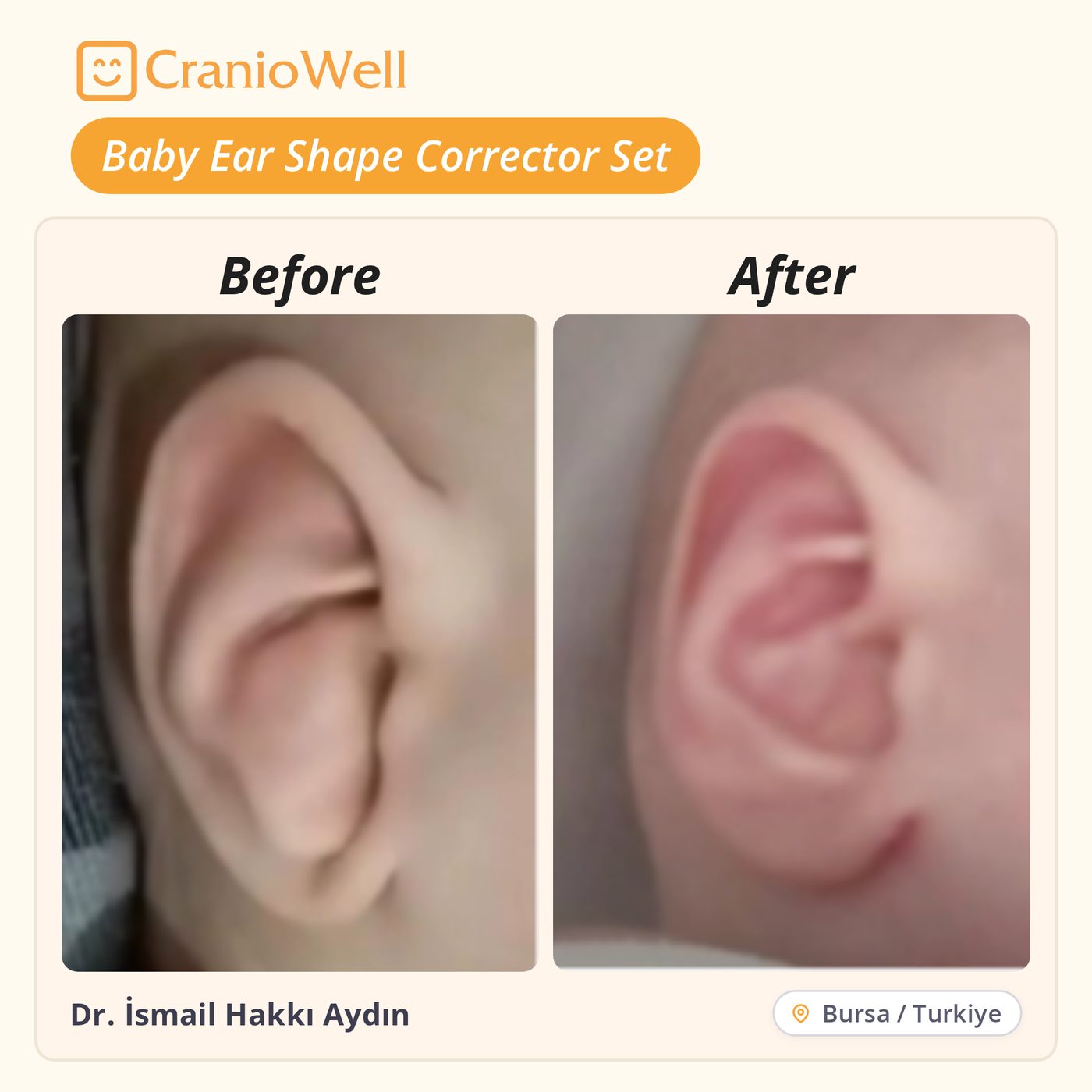 Before and after infant ear molding by Dr. İsmail Hakkı Aydın, Bursa