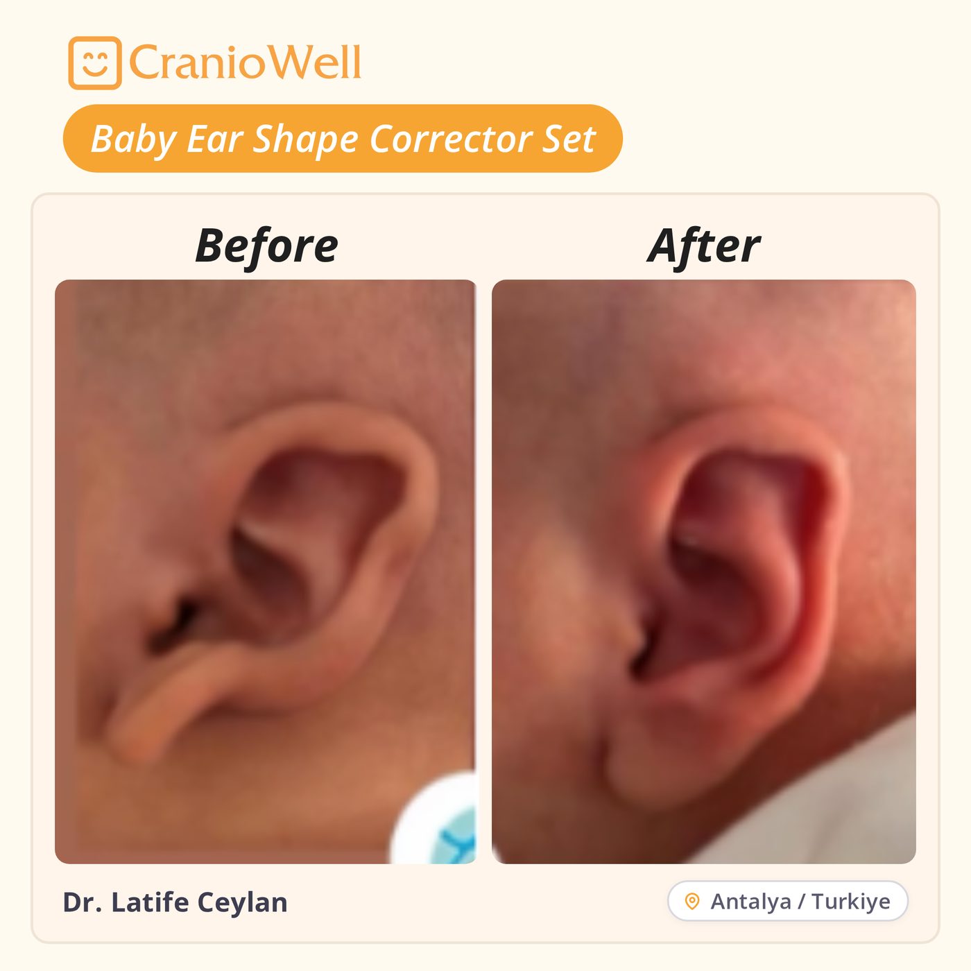 Before and after infant ear molding by Dr. Latife Ceylan, Antalya