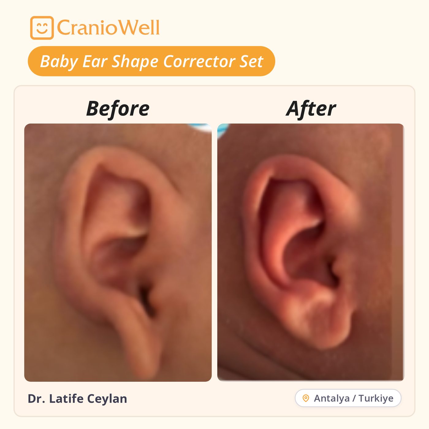 Before and after infant ear molding by Dr. Latife Ceylan, Antalya