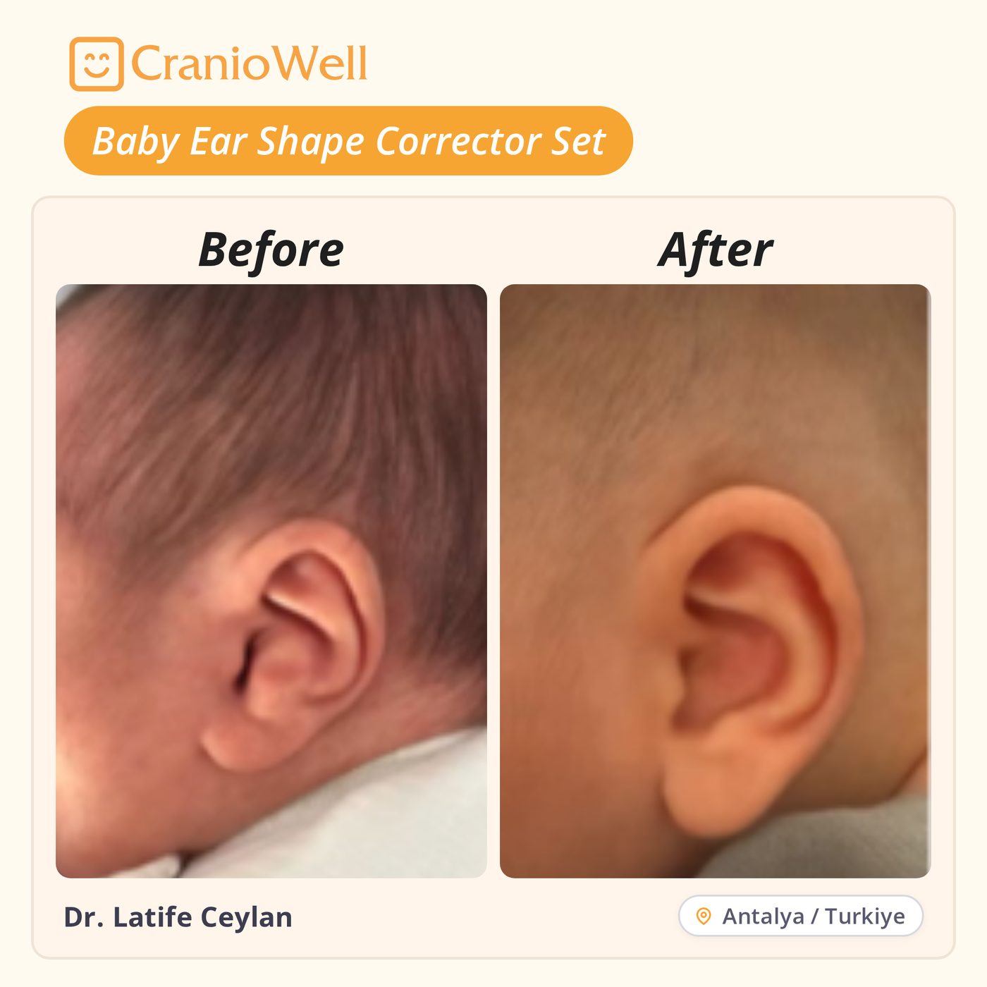 Before and after infant ear molding by Dr. Latife Ceylan, Antalya