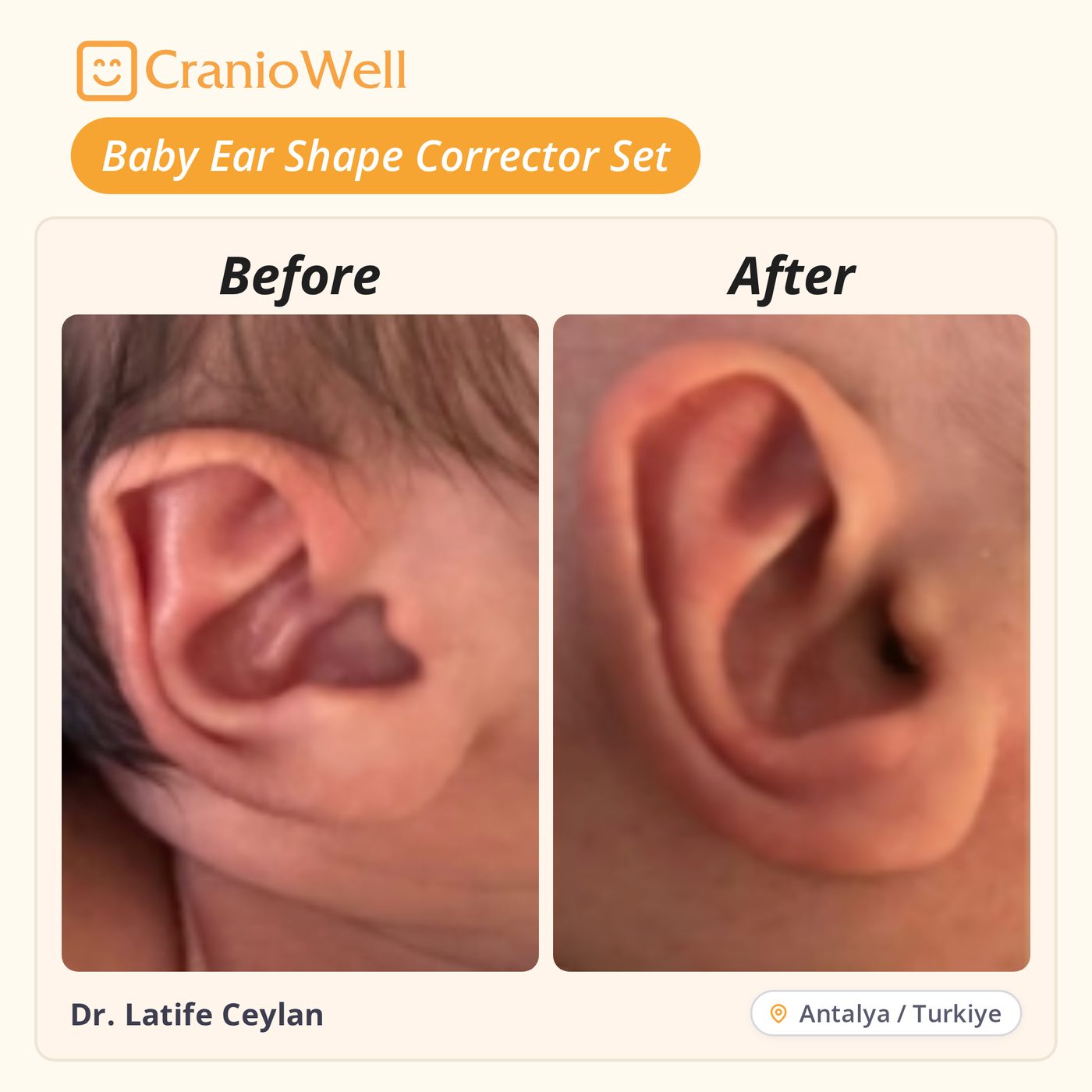 Before and after infant ear molding by Dr. Latife Ceylan, Antalya