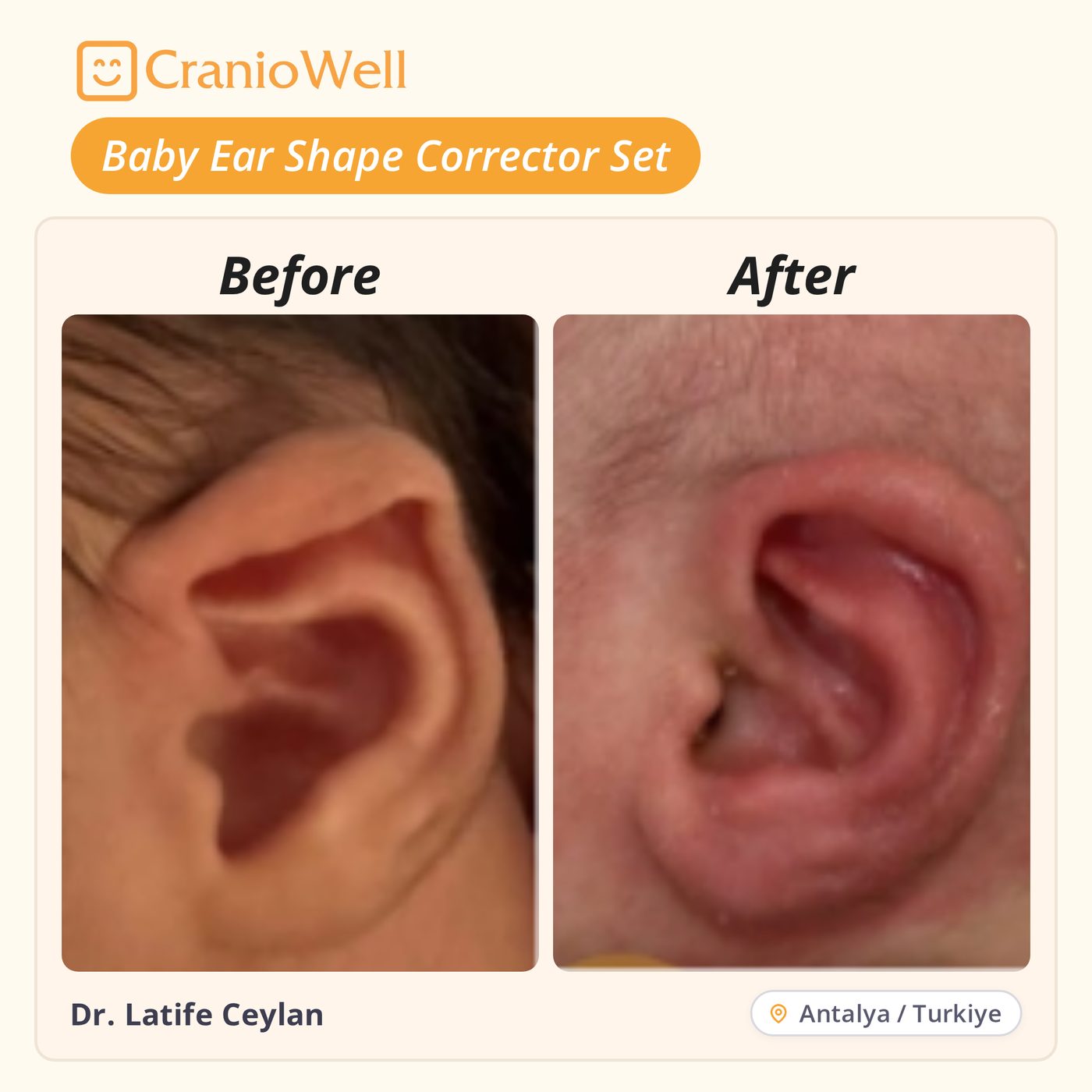 Before and after infant ear molding by Dr. Latife Ceylan, Antalya