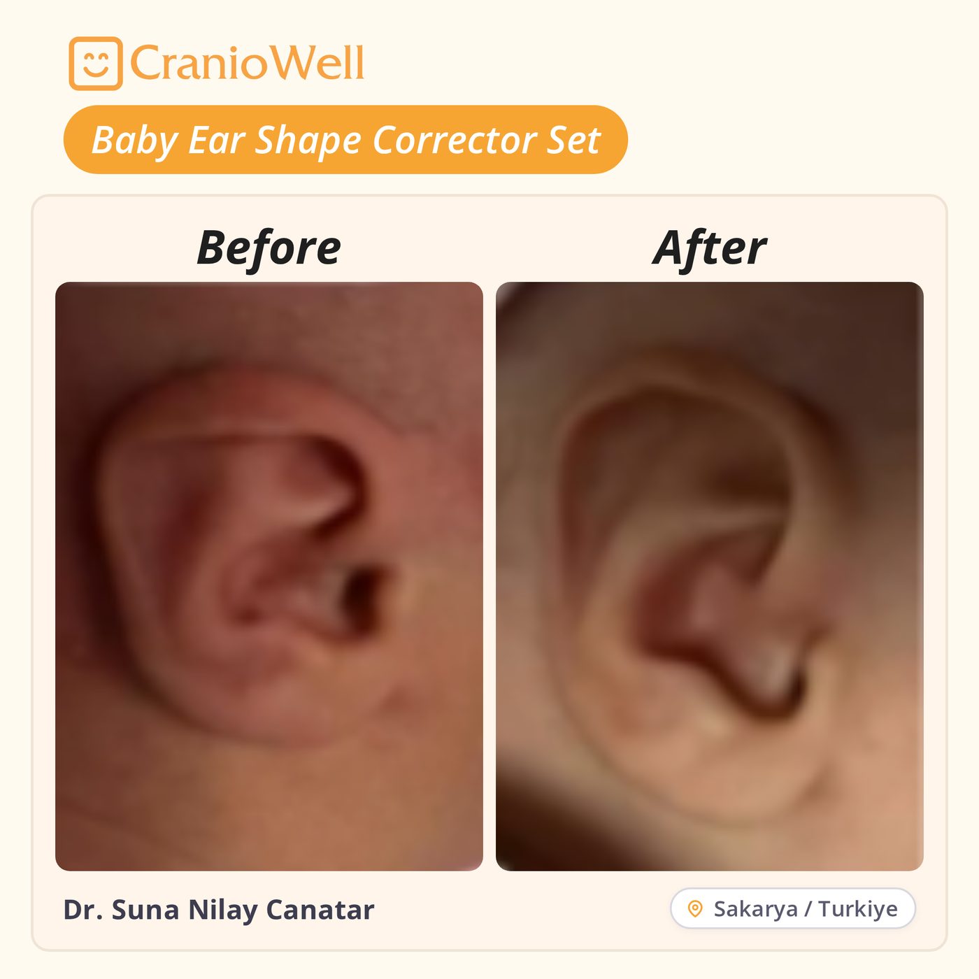 Before and after infant ear molding by Dr. Suna Nilay Canatar, Sakarya