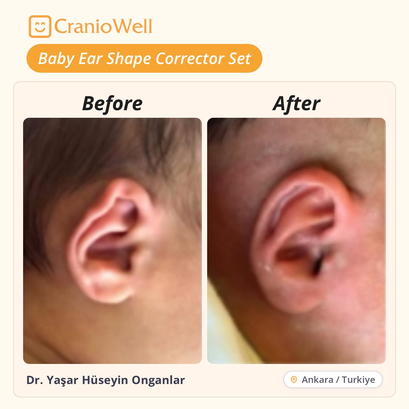 Before and after infant ear molding by Dr. Yaşar Hüseyin Onganlar, Ankara