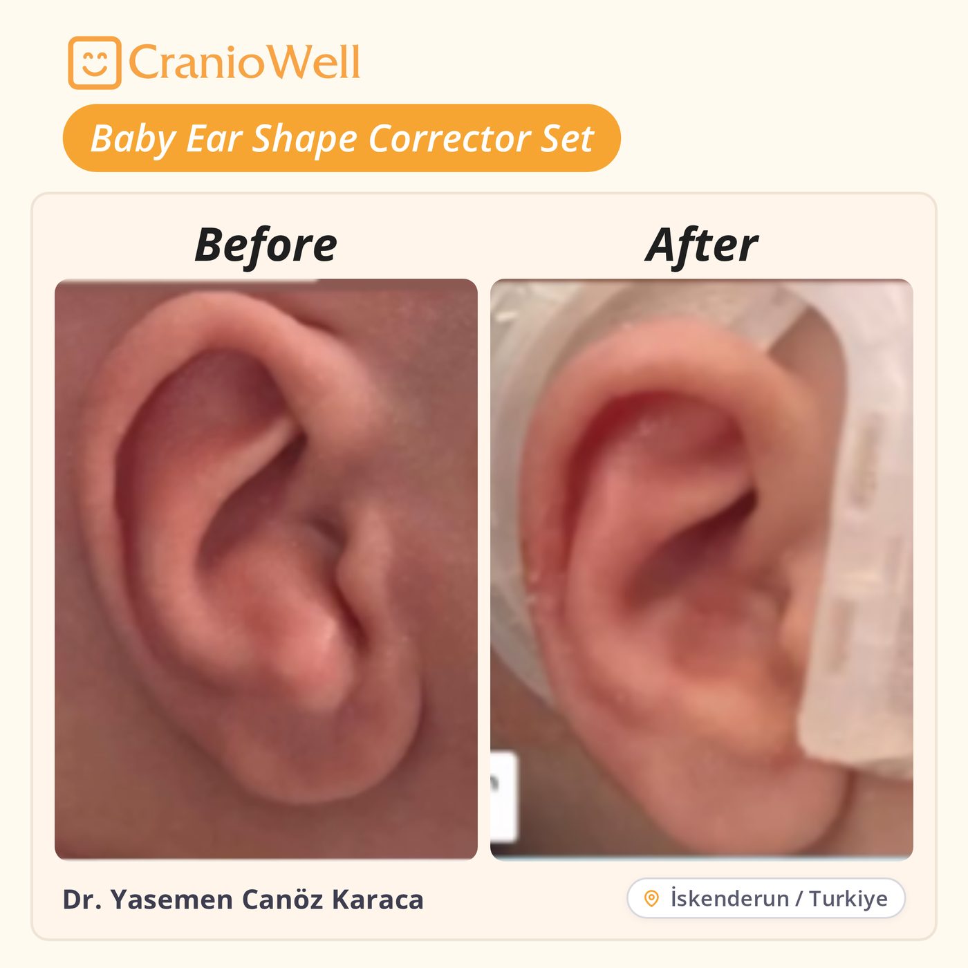 Before and after infant ear molding by Dr. Yasemen Canöz Karaca, İskenderun